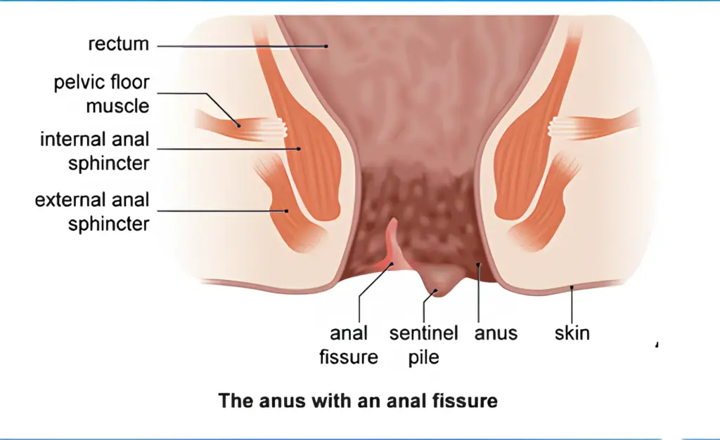 Anal Fissure