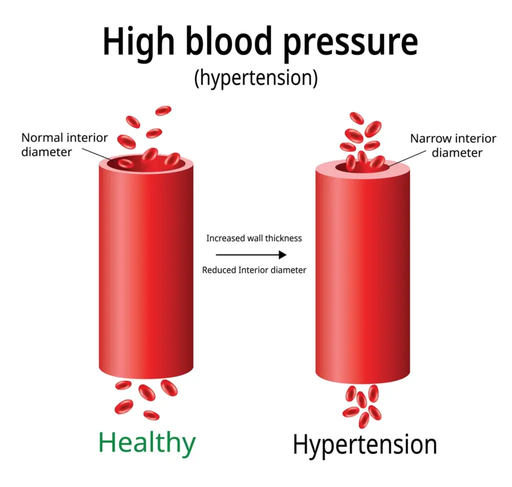 High Blood Pressure